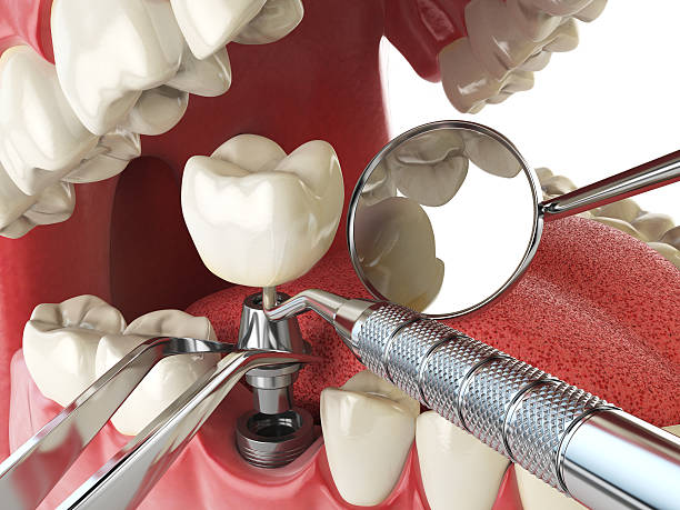 Best Emergency Root Canal Therapy in Ingram, TX